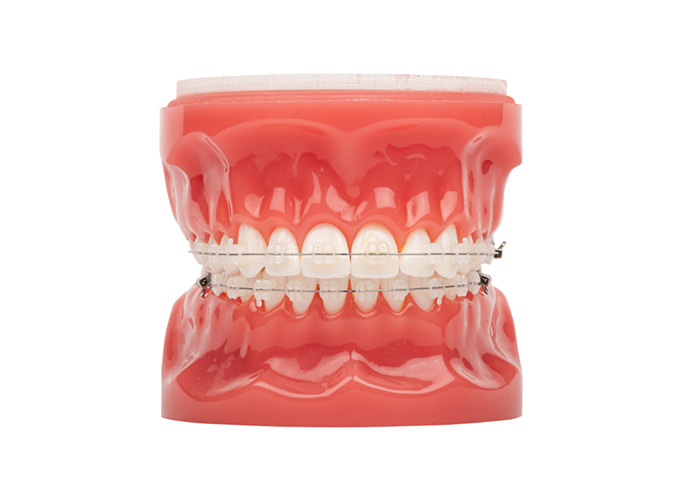 Dental model showing ceramic braces on teeth used at SS Orthodontics in Glendale and Phoenix, AZ