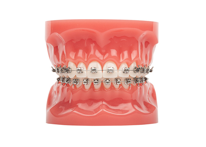 Dental model with traditional metal braces provided at SS Orthodontics in Glendale and Phoenix, AZ