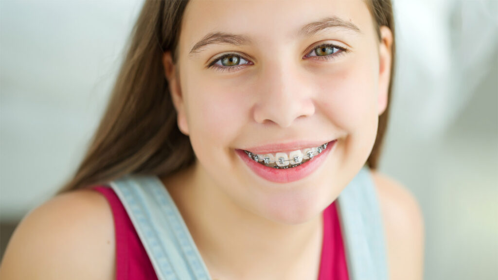 Beautiful Smile with Traditional Braces - Glendale Orthodontic Group