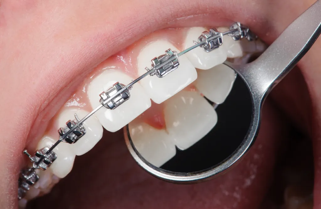 close-up-dental-braces-on-teeth-orthodontic-treat